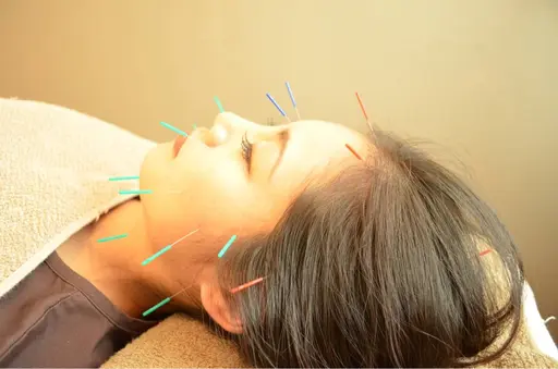 メイクしたままOK✨【カラダの鍼灸＋お顔の鍼＋ヘッドマッサージ　全身美容鍼モニター60分】