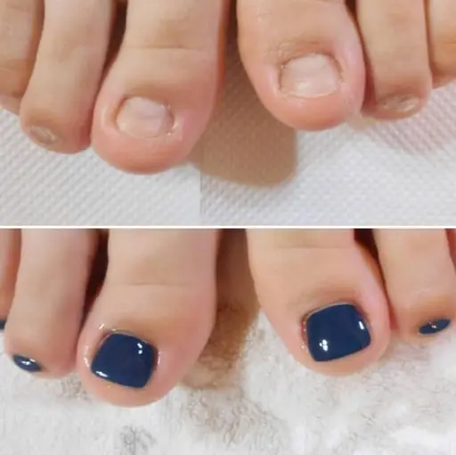 🦶【初回限定】🌿フット深爪矯正《ケア＋長さ出し＋ワンカラー仕上げ》