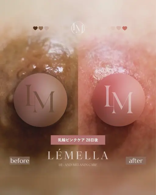 《ルメラ🥣》乳輪.脇.肘.膝.唇.お尻 ¥39000~インスタ予約のみ@milimili.lemella