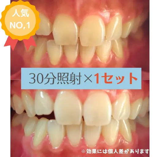 予約人気1位【1日3名限定】ホワイトニング30分×1セット☆¥4,900 → ¥2,500