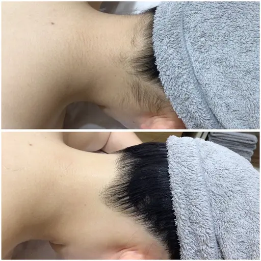 🩷18歳​〜​22歳限定価格🩷成人式に向けても◎脇・VIO•顔•うなじ•足•腕などセレクト脱毛✨