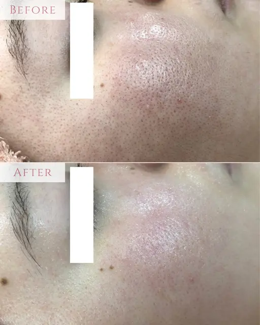 【年末SALE❤️‍🔥】リピーター続出❗️剥離なしピーリングで磨き上げる素肌美✨初回¥11,000→¥7000