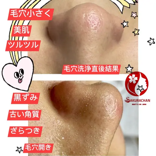 【Sale】🌸特別毛穴洗浄＋毛穴洗浄美肌パック＋ヘッドスパ(全顔毛穴のざらつき・鼻黒ずみ・いちご鼻・ツルツヤ)