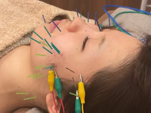 【平日限定‼️】電気美容鍼50本🪡＋小顔マッサージ