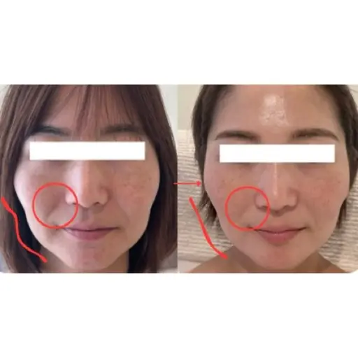 初回 整形級小顔&自分至上最高のお肌を作る