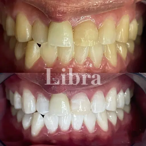 🌈【当日限定】超🉐初回0円🌈初めての方専用🦷✨ 15分照射で白さ実感🔥