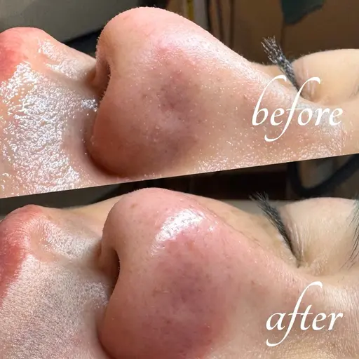 ミニモSALE✨【お顔の全面ケア】J-PEEL角質除去+ハイドロ毛穴洗浄+高保湿パック