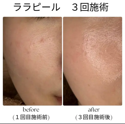 ララピール✖️毛穴洗浄(ニキビに特化した美容液を使用！ニキビをすぐ改善したい方におすすめ❣️)