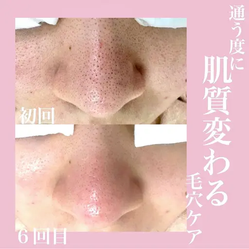 🟡7/19 15:00/16:30募集🟡黒ずみ・詰まり限定【毛穴洗浄フェイシャル】無料撮影モデル🔴ご利用条件要確認