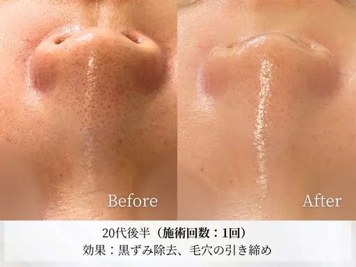 NEWオープン特別《毛穴洗浄＋毛穴吸引》気になる鼻の毛穴ごっそりとれる！ザラつき鼻さようなら✨️酵素洗顔付き