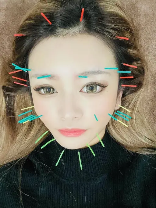 【期間限定/ビフォーアフター/口コミ投稿必須】フェイシャル小顔美容鍼【メイクしたままOK ／メンズOK】