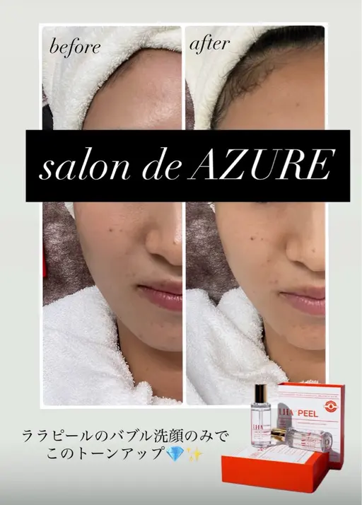 【韓国発▼第４世代ピーリング】ララピール◆毛穴ケア/ツヤ肌/ニキビ/リフトアップ◆ ダウンタイム、剥離なし！