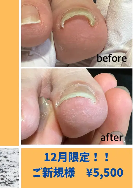 🎅12月ご新規様限定🎄 全巻き爪補正 ¥5,500