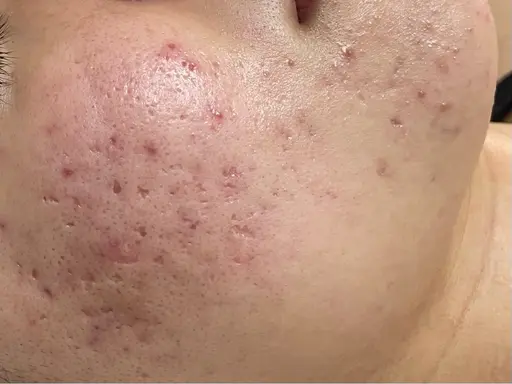 【毛穴・ニキビ】塗るリジュラン導入