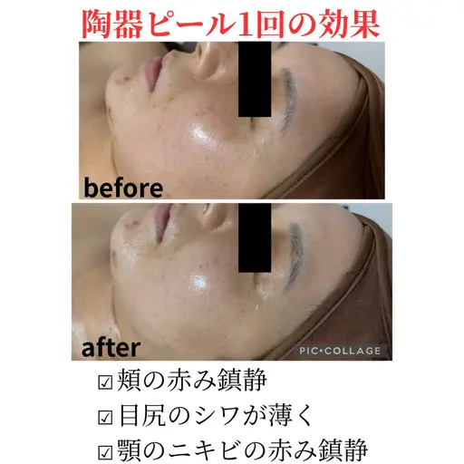 《ニキビ毛穴レスツヤ肌コース》