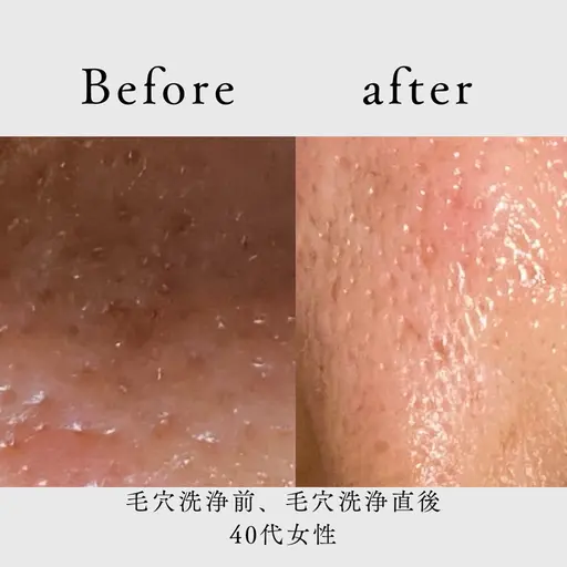 毛穴洗浄＆潤い美肌ケア（40分）［毛穴汚れ／皮脂／黒ずみ／角栓／ニキビ／ニキビ跡にアプローチ］