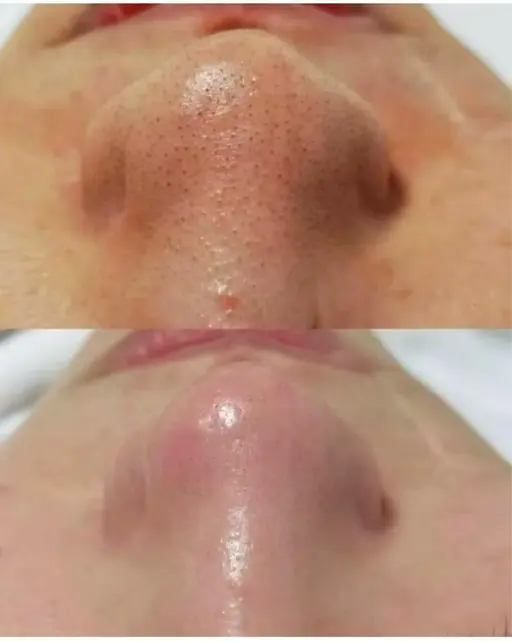 【黒ずみ毛穴/ニキビケア/角質除去】毛穴掃除コース