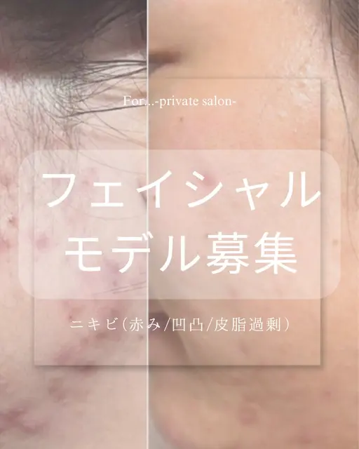 🫧【モデル募集】毛穴つるん♡角栓クリア40分(クレンジング→悩み別ピーリング→マスク→仕上げ)