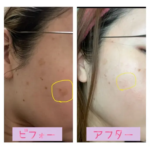 【ベーシック】毛穴洗浄＋リンパフェイシャル 💆‍♀️（60分）　《毛穴の黒ずみ・ザラつきケア×すっきり小顔》