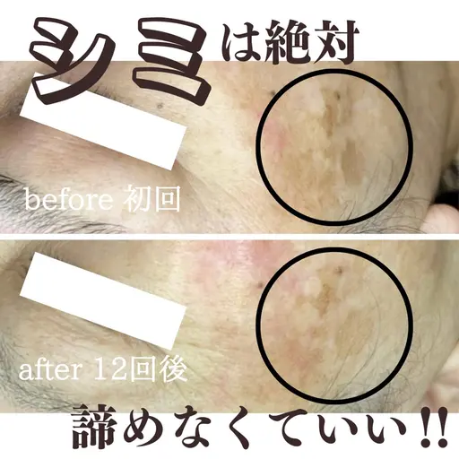 【最新の次世代シミケア】20ショット