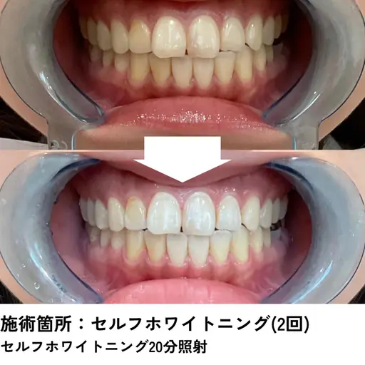 【セルフホワイトニング】プレミアムケア‎💎高濃度配合ジェル×ハイパワー3色LEDで効果実感✨20分×2回