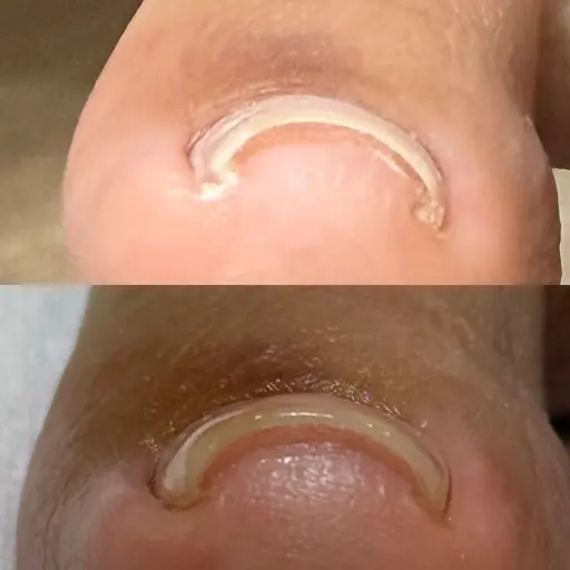 HeySwitch巻き爪ケアモデル様募集