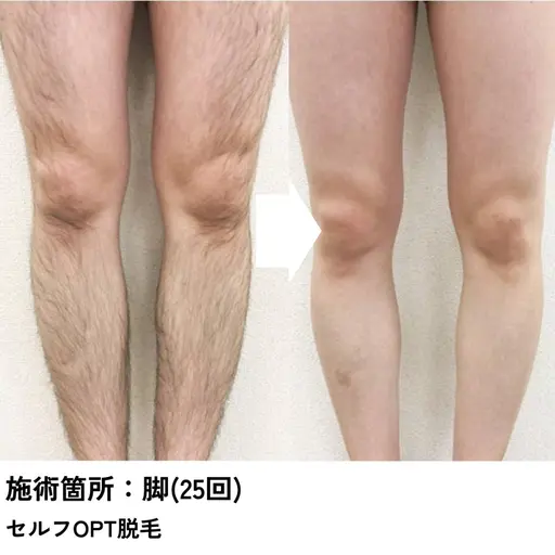 【脱毛】セルフ脱毛30分間打ち放題！時間内ショット無制限で好きなだけ👍🏻⸒⸒ 顔/腕/脇/脚...