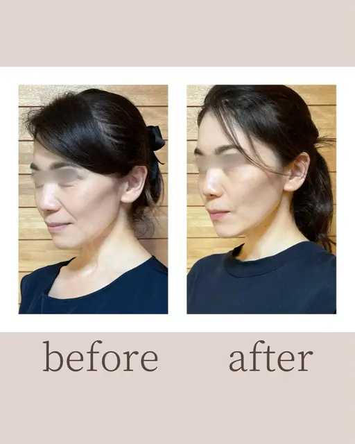 【モニター】リフトアップ♪魔法の小顔ケア