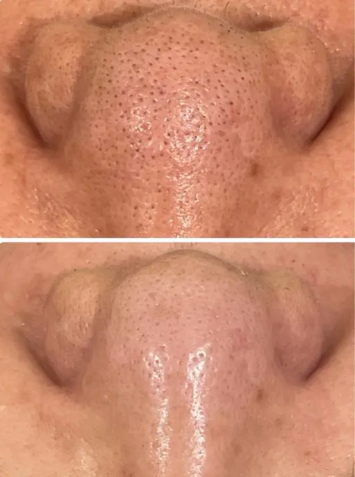 毛穴洗浄✨こんな黒ずみにお悩みの方！モニター様