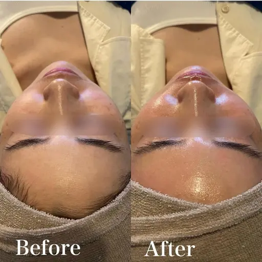 【女性】フェイシャルwax脱毛
