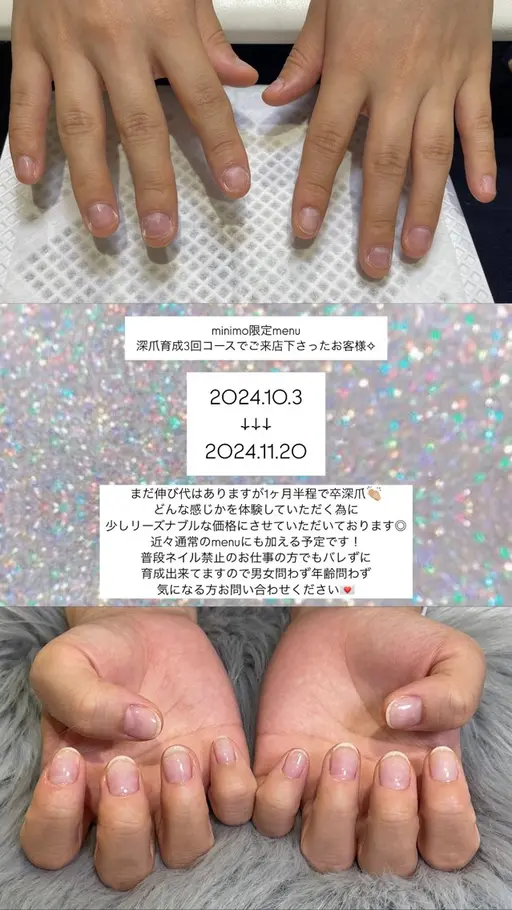 深爪育成💡ジェルワンカラー付き【3回分】🤝🏼✨深爪でお悩みの方是非✨