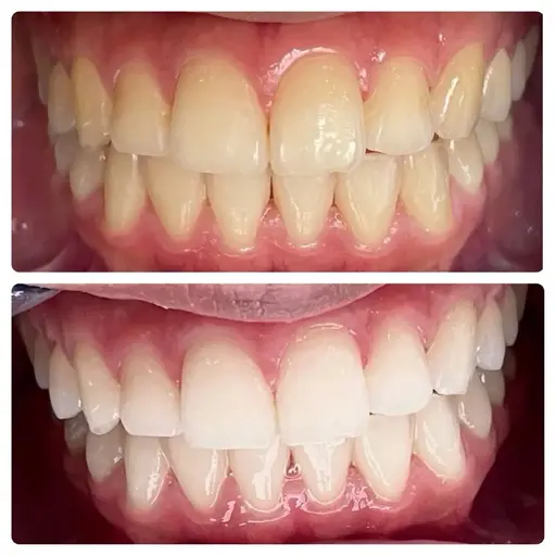 【当日限定】歯の黄ばみにセルフホワイトニング体験メニュー🦷8分×3回で効果実感🩵セルフで簡単本格ケア✨駅チカ