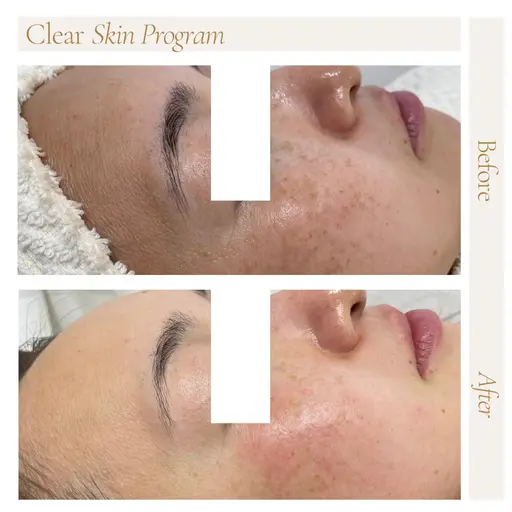 【CSPフェイシャルワックス×圧倒的美白ケア】全顔1回