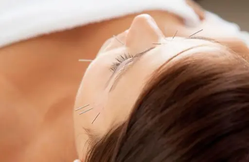 美容鍼