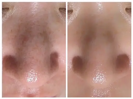 【人気Ｎｏ．1毛穴大洗浄ケア】黒ずみ除去＋小顔造形リンパエステ60分¥3000