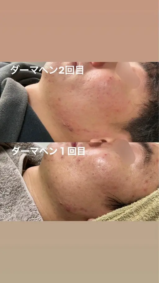 リピ率100%❣️痛くないダーマペン！ニキビ跡・毛穴・乾燥肌に◎出血❌ダウンタイム❌毛穴洗浄付✨(価格変動有)