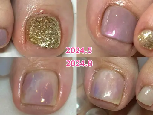 【巻き爪矯正つき】シンプルデザイン