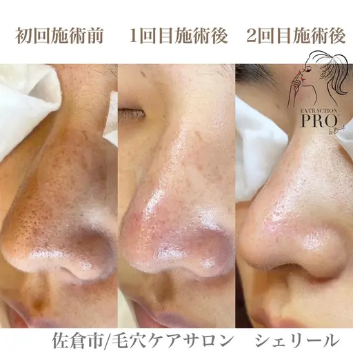 毛穴エクストラクション