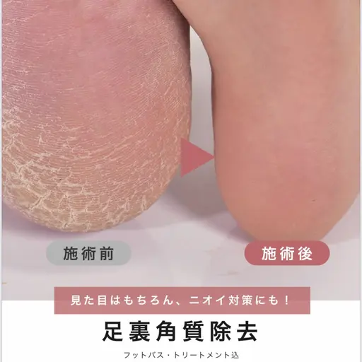 【🛁フット角質ケア】足裏 角質ケア（フットバス＆保湿付✨)