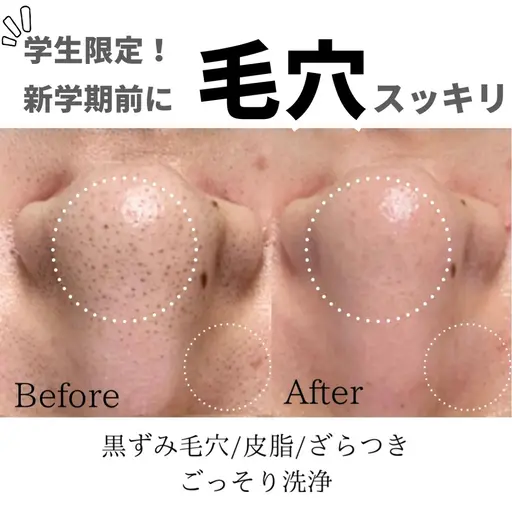 【学生限定👩‍🎓】ごっそり毛穴洗浄❗️水素毛穴洗浄+高保湿パック✨隙間時間でツヤGET🤍(ミニモ学割.時間限定)