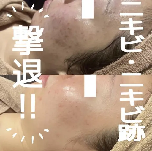 5月限定🌈肌育👶🏻剥離あり🌿ハーブピーリングでトラブルゼロの陶器肌革命✨今までの肌悩み完全解決メニュー😭
