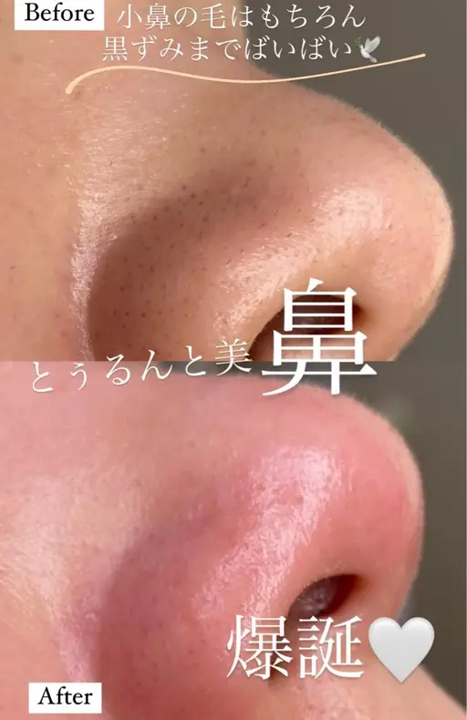 🌟女性🌟ブラジリアンワックス脱毛 フェイシャル【額.頬.口周り.フェイスライン】