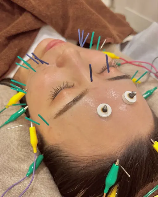 人気No.1✨迷ったらまずはこれ❣️【美容鍼】お試し電気美容鍼60分 ￥9,900 → ￥3,900