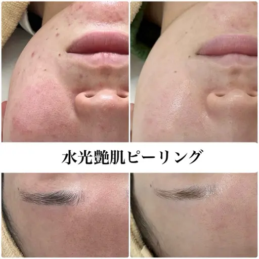 【平日限定*肌質改善】毛穴浮きや化粧ノリの悪さ*ニキビ*ざらつきに♪水光ピーリングでちゅるちゅる素肌へ🫧パック付き❤︎