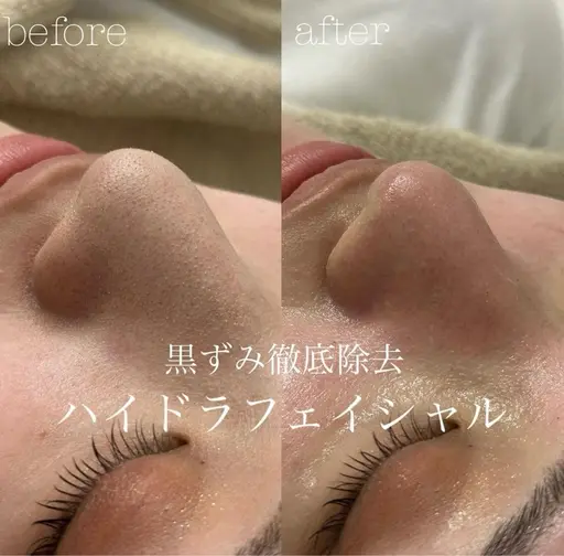 【7/22​〜​31日ご予約限定❤️】水素ハイドラフェイシャルフルコース💆🏼‍♀️