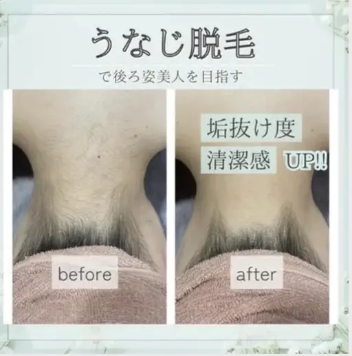 2026年成人式前うなじ脱毛👘🎍脱毛未経験の方大歓迎🥳着物を着るなら襟足の脱毛は必須です✨