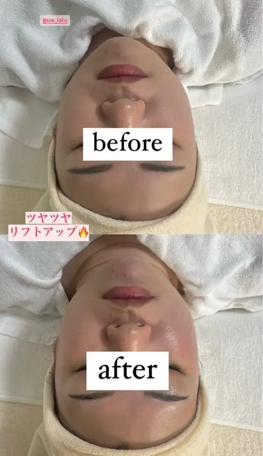 【minimo限定✨】水光肌✖️毛穴洗浄フェイシャルエステ💆🏻‍♀️