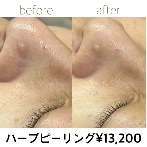 ハーブピーリング🌿剥離なし・ダウンタイムなし