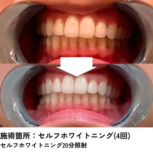 ⚡タイムセール⚡セルフホワイトニング　40分照射　¥5180→＼¥4980／