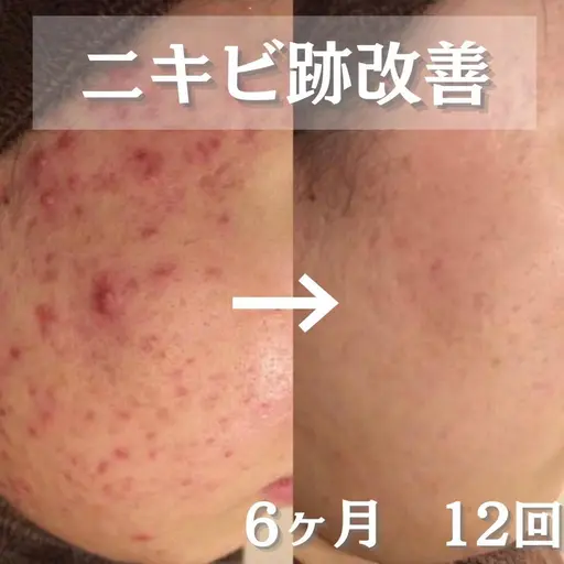 【😭しつこく残るニキビ跡😭】色素沈着したニキビ跡に！ピーリング+W鎮静パック+フットマッサージ(20分)🌷